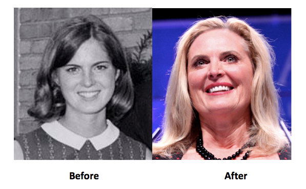 Ann Romney Plastic Surgery