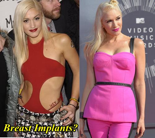 Gwen-Stefani-Breast-Implants