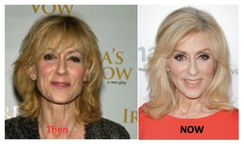 Judith Light Plastic Surgery Before and After - Latest Plastic Surgery
