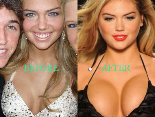 Kate-Upton-Breast-Implants-Before-and-After-Photo