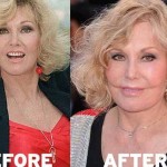 Kim Novak Plastic Surgery Before And After