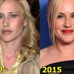 Patricia Arquette Plastic Surgery Before And After Photos