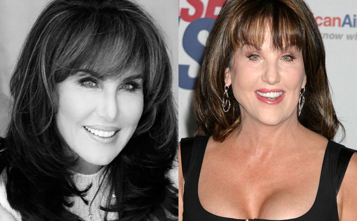 Robin-Mcgraw-plastic-surgery-Before-and-After-Lip-Jobs-Botox-Photos-2