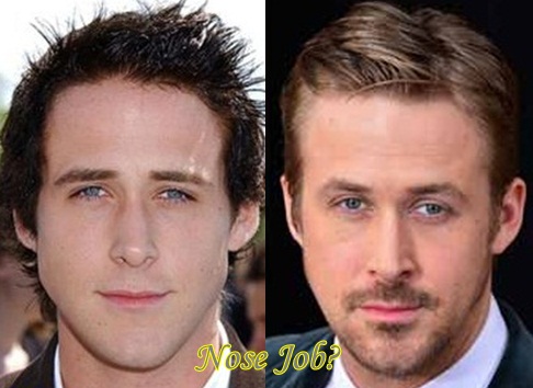 Ryan-Gosling-Plastic-Surgery