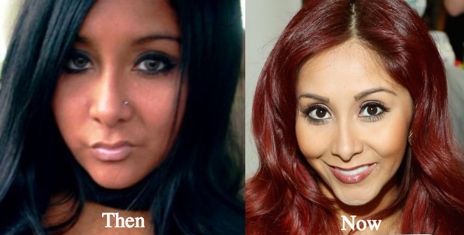 Snooki plastic surgery before and after photos