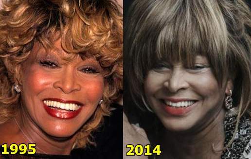 Tina-Turner-Plastic-Surgery-Before-and-After