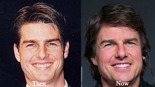 Tom Cruise teeth before and after - Latest Plastic Surgery Gossip And