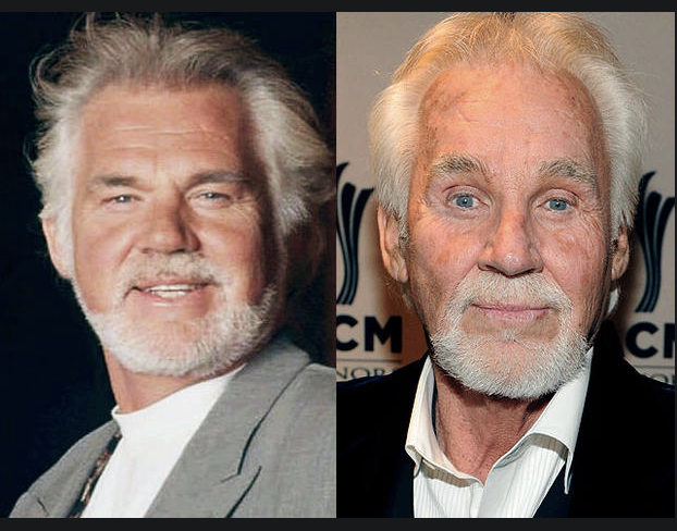 Kenny Rogers Plastic Surgery before and after