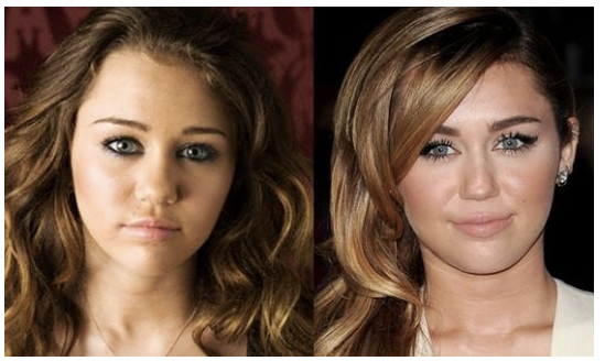 Miley Cyrus plastic surgery pictures