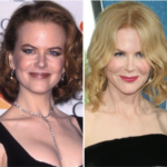 Nicole Kidman Plastic Surgery – Before and After Photos