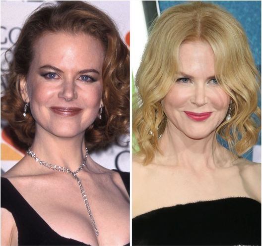 Nicole Kidman plastic surgery images