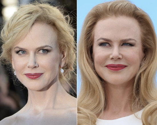 Nicole Kidman Plastic surgery images