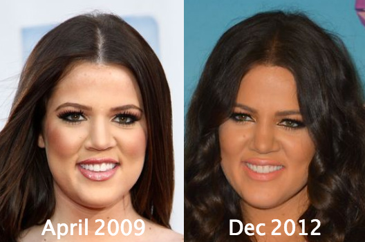 Khloe Kardashian Before and After Plastic Surgery