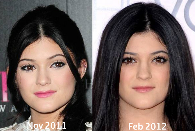 Kylie Jenner Before Plastic Surgery 2