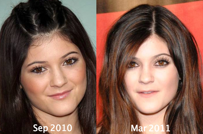 Young Kylie Jenner before all the cosmetic surgeries