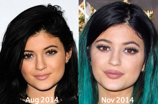 Kylie Jenner Plastic surgery 4