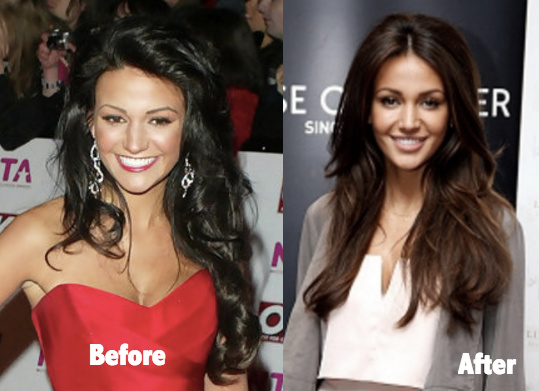 Michelle Keegan before and after plastic surgery comparison