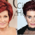 Sharon Osbourne Before Plastic Surgery – Looks Puffy After