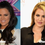 Khloe Kardashian Before and After Plastic Surgery – Butt Lifts and Botox Fillers