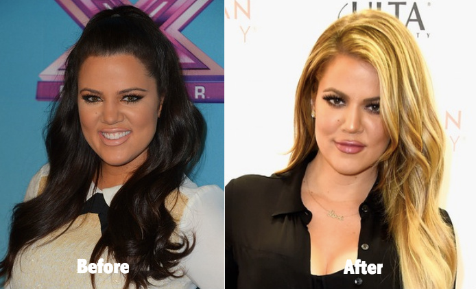 Khloe Kardashian Plastic surgery before and after 