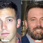 Ben Affleck Plastic Surgery Before and After Photos