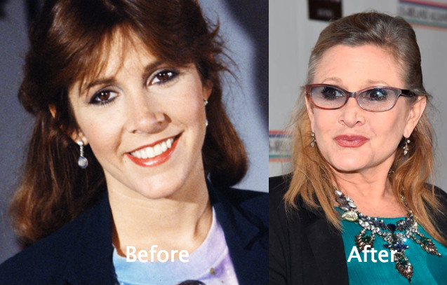 Carrie Fisher cosmetic surgery rumors