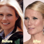 Gwyneth Paltrow Plastic Surgery Before and After Botox
