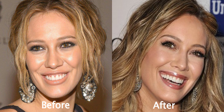 Hilary Duff Plastic Surgery smiles better now