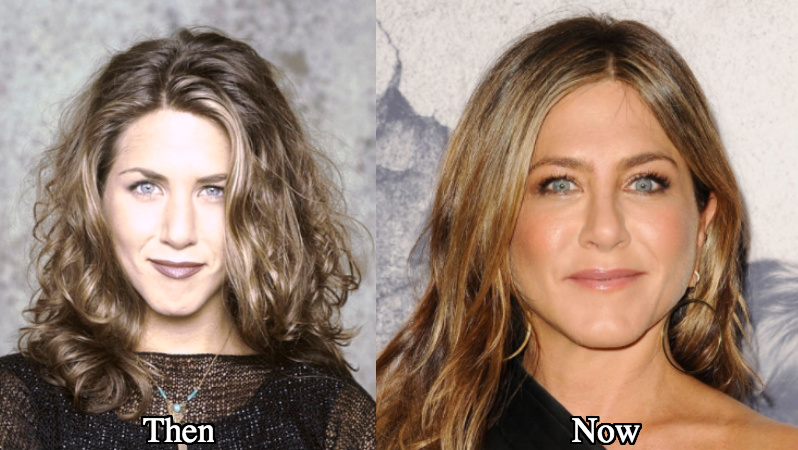 Jennifer Aniston botox fillers before and after