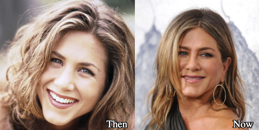 Jennifer Aniston plastic surgery rumors before and after