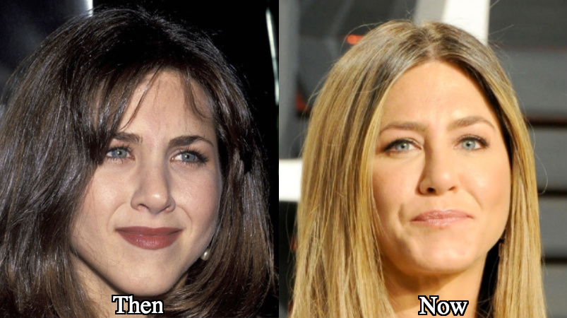 Jennifer Aniston rhinoplasty before and after photos