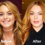 Lindsay Lohan Plastic Surgery Before and After Photos