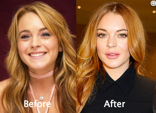 Lindsay Lohan Cosmetic Surgery Before and AFter