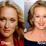 Meryl Streep Plastic Surgery Before and After Photos