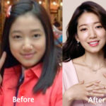 Park Shin Hye Plastic Surgery Before and After Photos