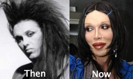 Pete Burns cosmetic surgery included numerous lip fillers