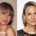 Renee Zellweger Plastic Surgery Before And After Photos