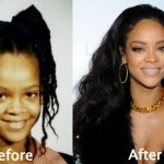 Rihanna Plastic Surgery Before and After Photos