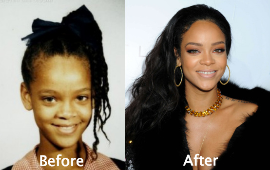 Rihanna Plastic Surgery breast implants and nose job