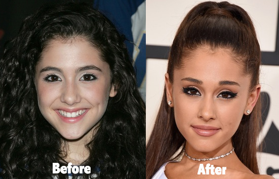 Ariana Grande Cosmetic Surgery Photos