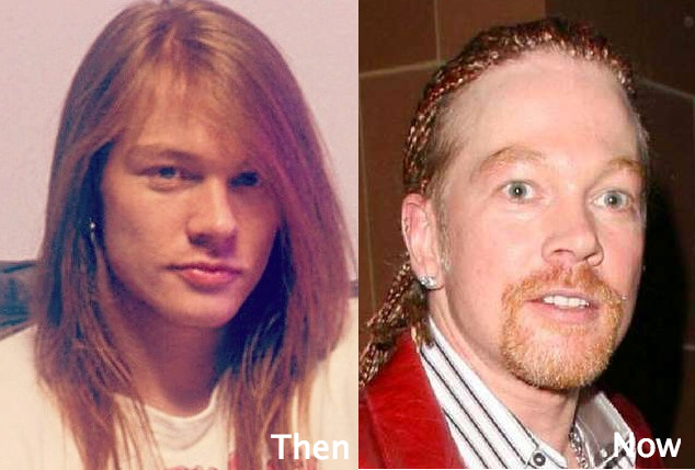 Axl Rose awful plastic surgery