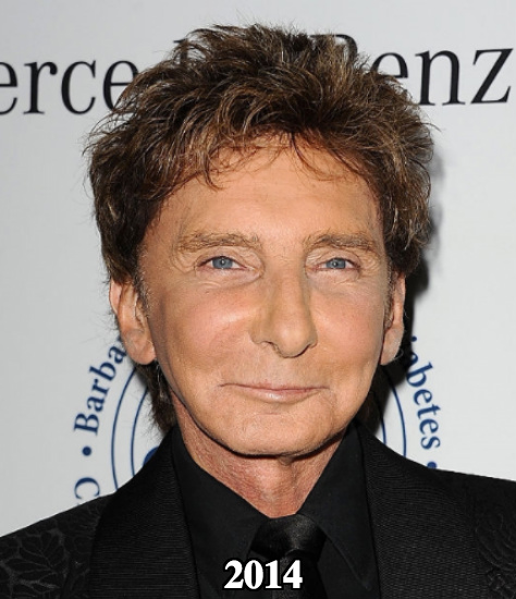 Barry Manilow botox and facial fillers cheek lift 2014