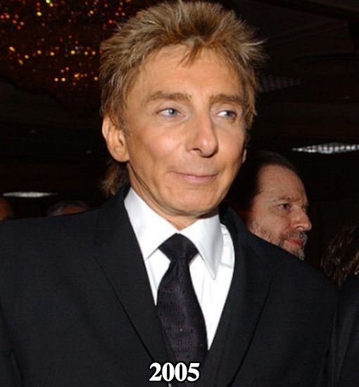Barry Manilow botox before and after 2005