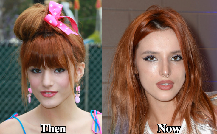Bella Thorne Rhinoplasty before and after photos