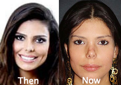 Bruna Felisberto awful plastic surgery