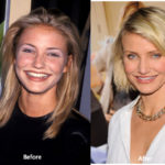Cameron Diaz Plastic Surgery Before and After Photos