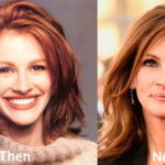 Julia Roberts Plastic Surgery Before and After