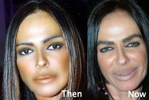 celebrity plastic surgery gone wrong