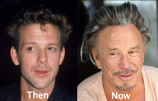 Mickey Rourke Cosmetic surgery before and after