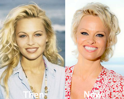 Pamela Anderson awful plastic surgery